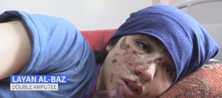 «Ξαναβάλτε μου τα πόδια μου, δεν θέλω τεχνητά…»-Συγκλονίζουν παιδιά που έχουν ακρωτηριαστεί στη Γάζα